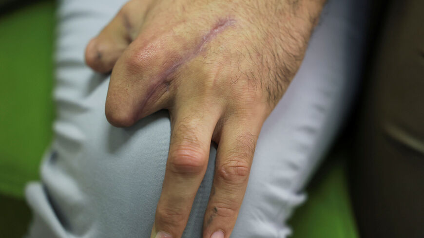 Mohammed Nasser al-Din, 34, director of the Engineering and Medical Equipment Department at Al-Rasoul Al-Aazam Hospital, a Hezbollah-affiliated facility, and was wounded when pagers detonated across Lebanon on September 17, 2024, sits in a room with some fingers missing, in Beirut, Lebanon September 15, 2025. REUTERS/Mohamed Azakir
