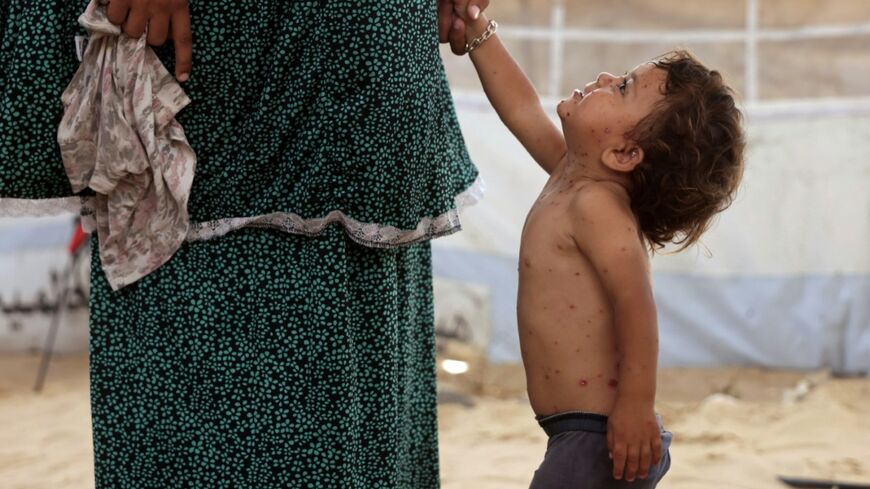 UNICEF said health officials had already recorded more than 9,300 suspected cases of chickenpox across Gaza in early July