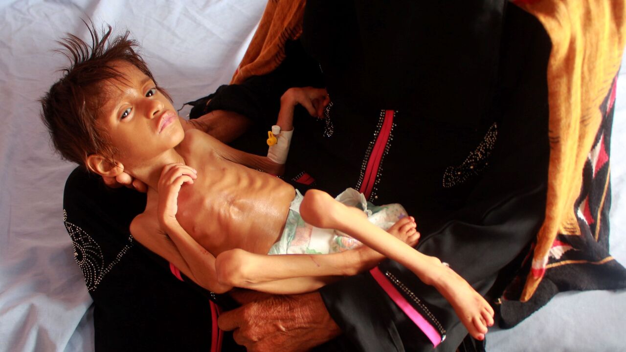 Yemen malnutrition
