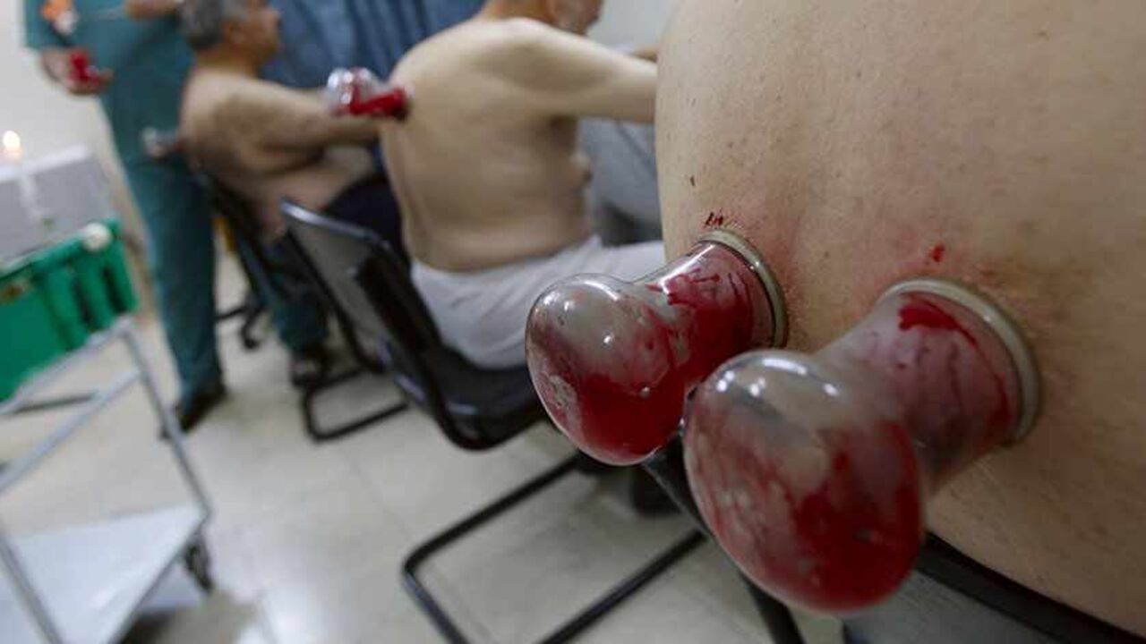 PALESTINIANS/ Assem al-Tamimi, a Palestinian doctor and Hijama specialist, treats patients at his clinic in the West Bank city of Hebron August 8, 2009. Hijama is a traditional Islamic treatment method that involves creating a vacuum on the skin by placing inverted cups on parts of the body and drawing blood from an incision on the skin. REUTERS/Nayef Hashlamoun (WEST BANK HEALTH IMAGES OF THE DAY) - RTR26IKP