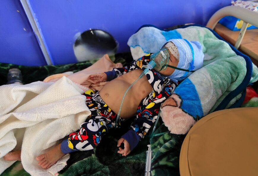 A Yemeni child suffering from malnutrition lies in a bed in the rebel-held capital Sanaa on September 25