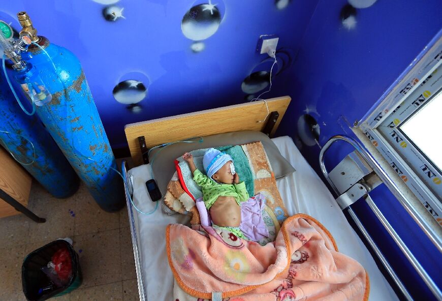 A Yemeni child suffering from malnutrition lies in a bed in a hospital in the Huthi-controlled capital Sanaa on September 25