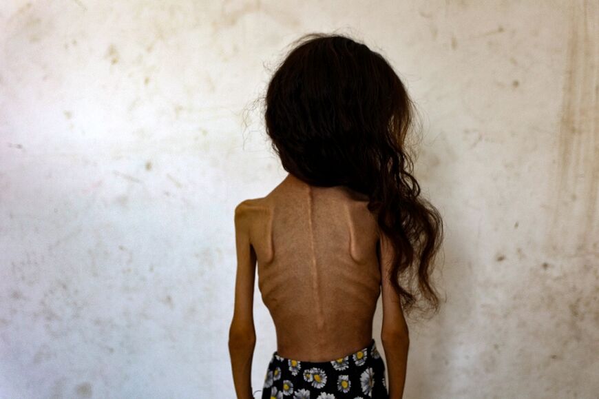 The mother of nine-year-old Mariam Dawwas said her daughter had no known illness and weighed 25 kilograms before the war, but has now dropped to 10 kilos